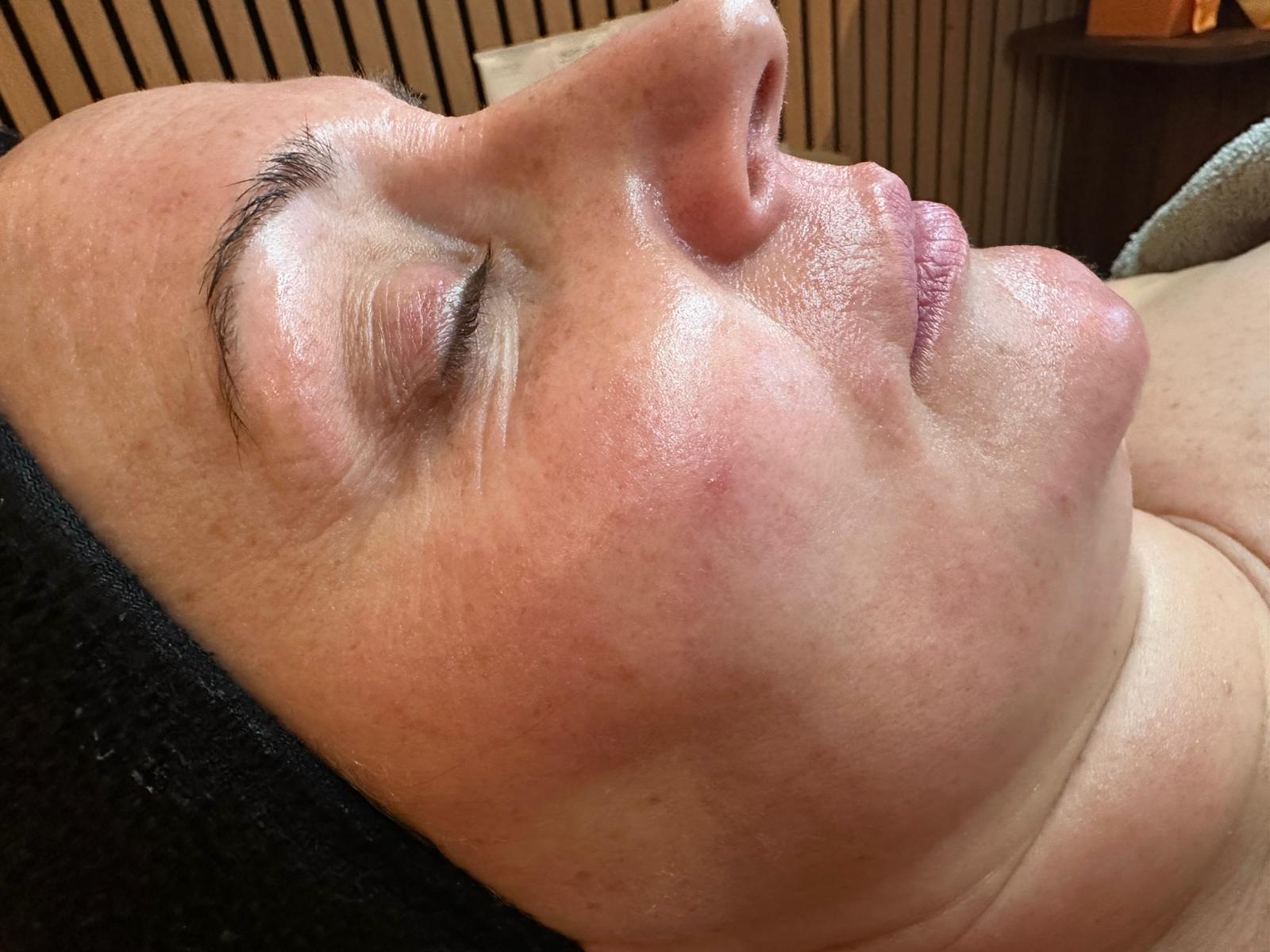 Na de behandeling — resultaat 1